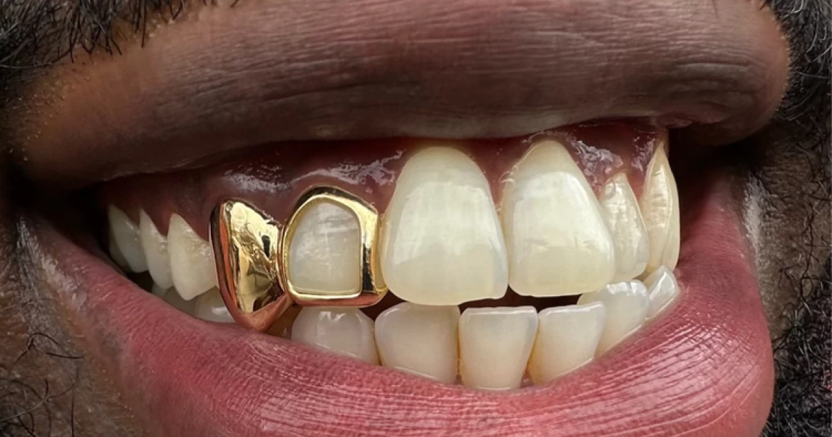 Discover the History of Grillz and Their Cultural Legacy